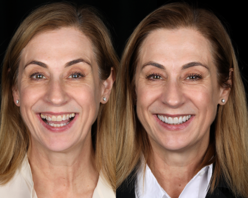 Before-After-Digital-Smile-Design-Treatment