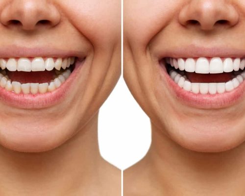 Before-and-after-shots