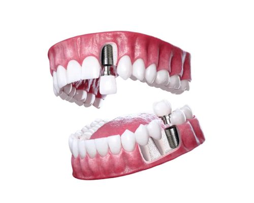 Dental-Implants-1