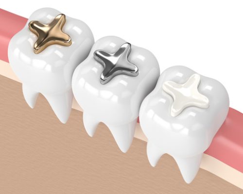 IMG-dental-fillings-GettyImages-925328752