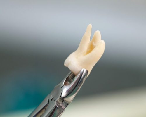 Wisdom-teeth-Extractions sharjah