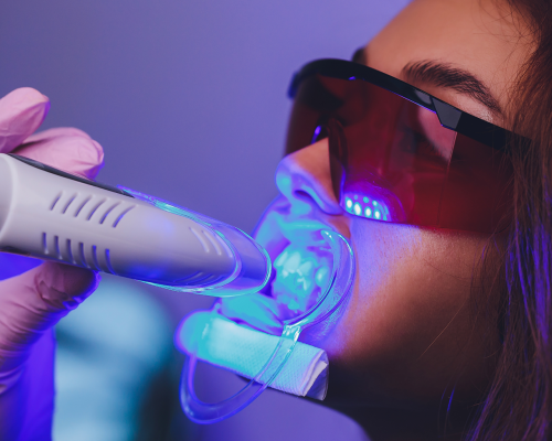 laser-teeth-cleaning-in-encino-ca